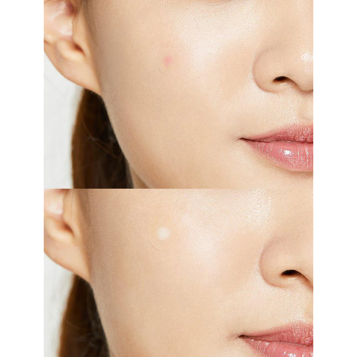 Acne treatment, highlighting hydrocolloid patches that maintain skin humidity and aid in overnight healing.